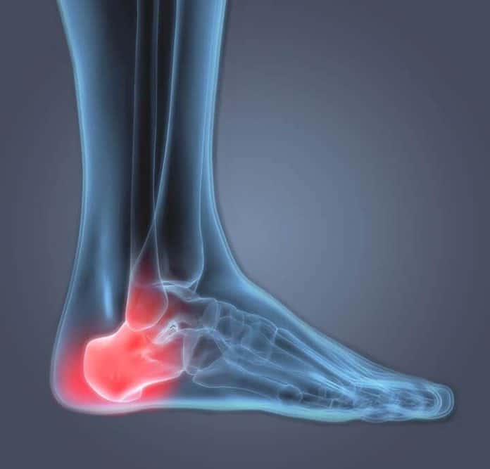 Heel Pain - KC Foot Care Thomas Bembynista DPM