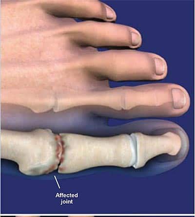 Hallux limitus - KC Foot Care Thomas Bembynista DPM