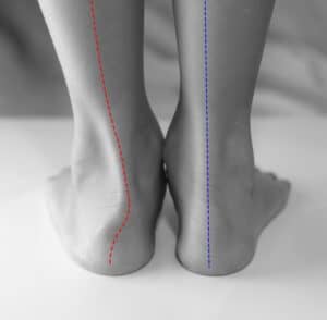 Weak Ankles